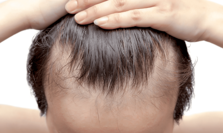 alopecia-androgenetica